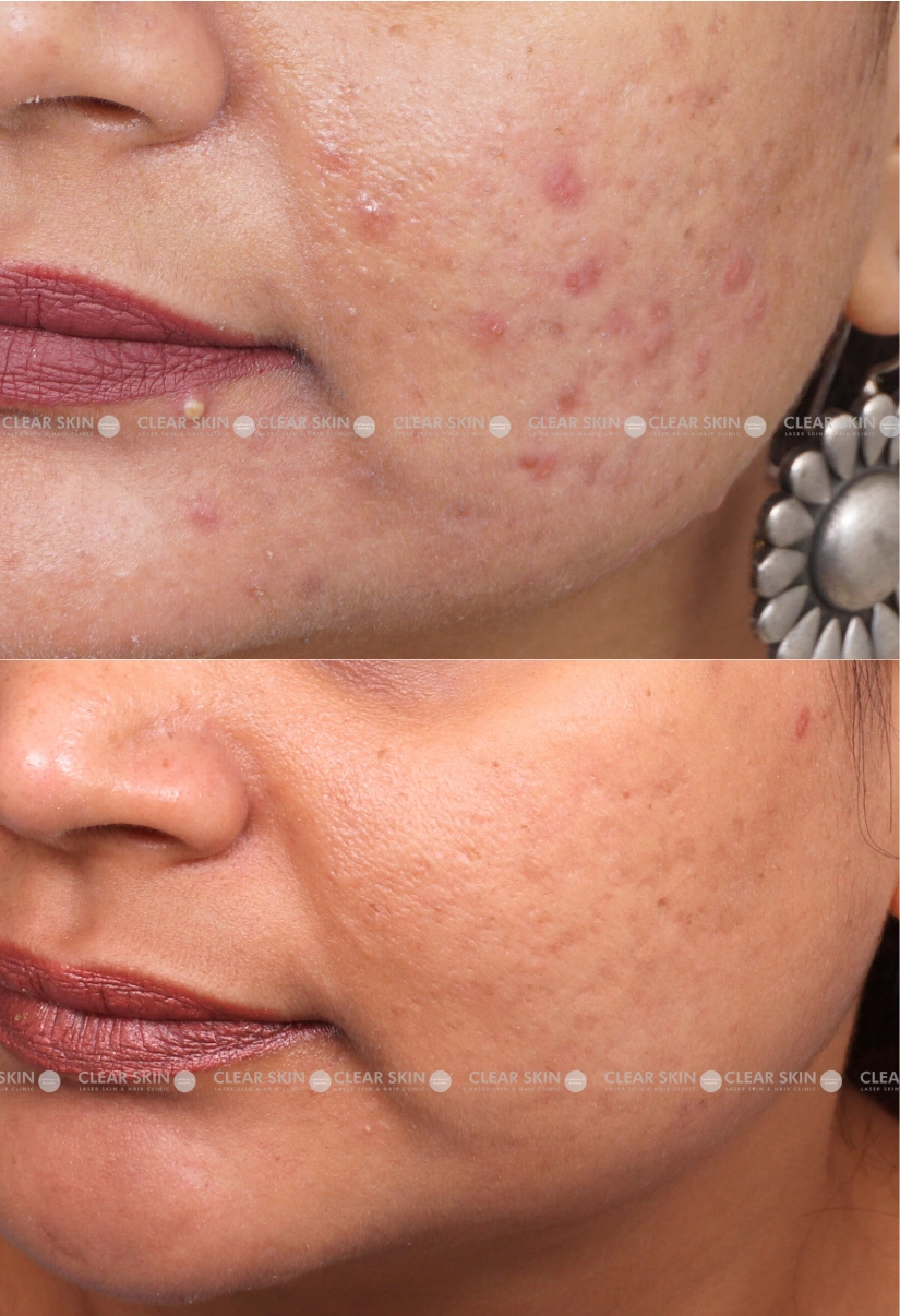 40yrs Female Acne Results 6 Months Timeline 7 Sessions ClearSkin Pune (3)