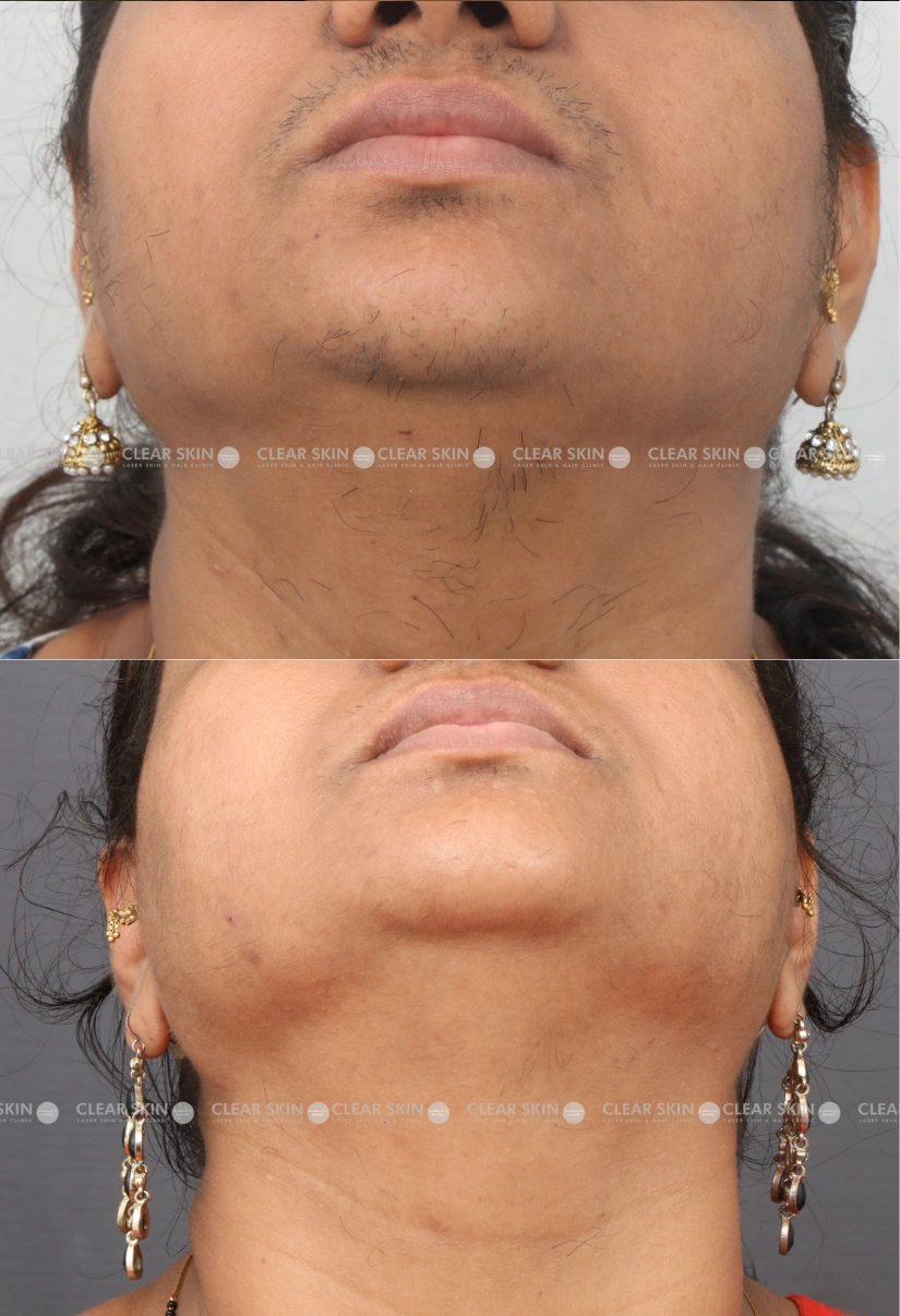 40yrs Female LHR Results 7 Months Timeline 7 Sessions ClearSkin Pune 3