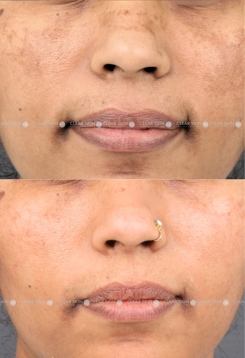 40yrs Female Melasma Results 6 Months Timeline 7 Sessions ClearSkin Pune (3)