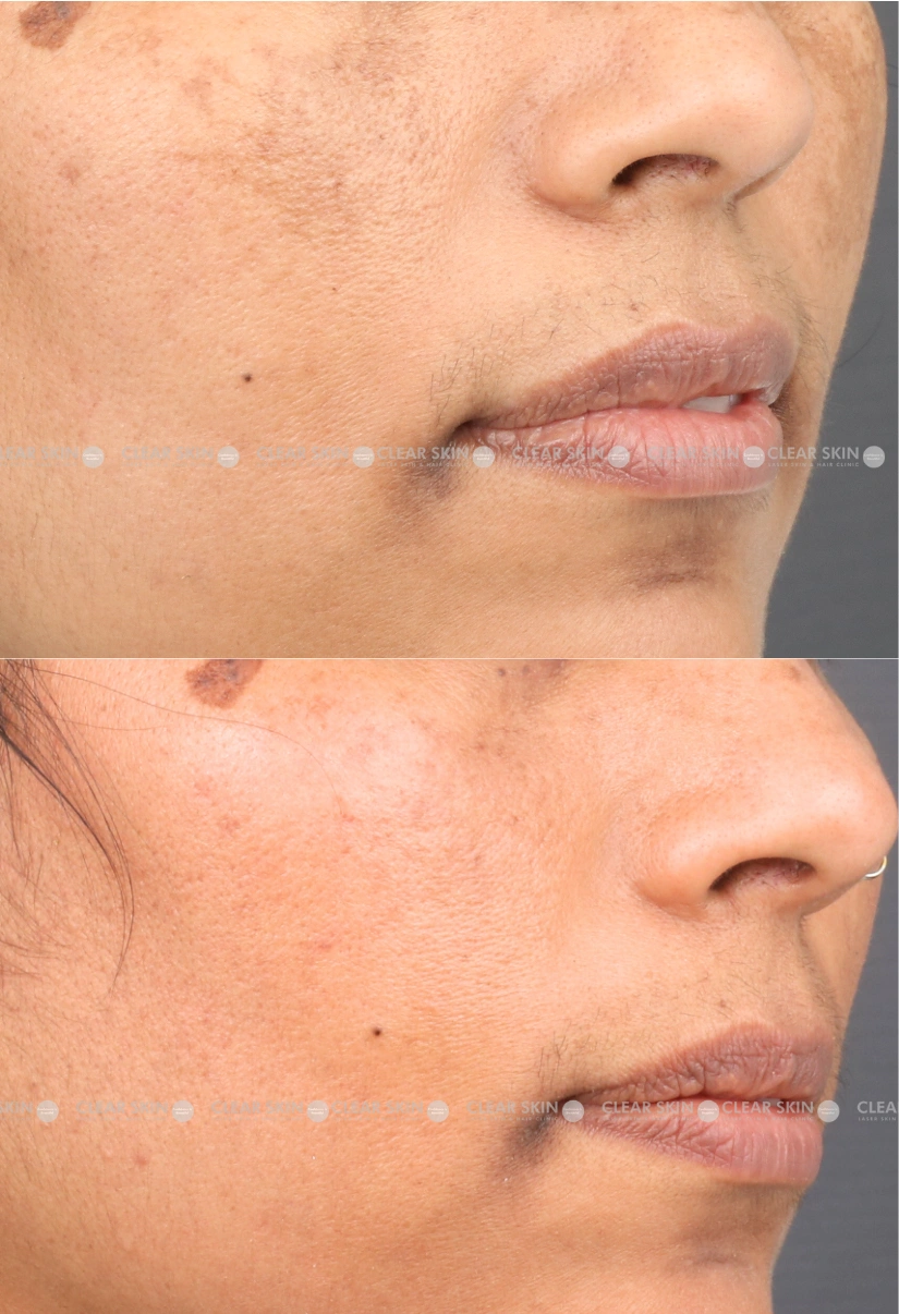 40yrs Female Melasma Results 6 Months Timeline 7 Sessions ClearSkin Pune