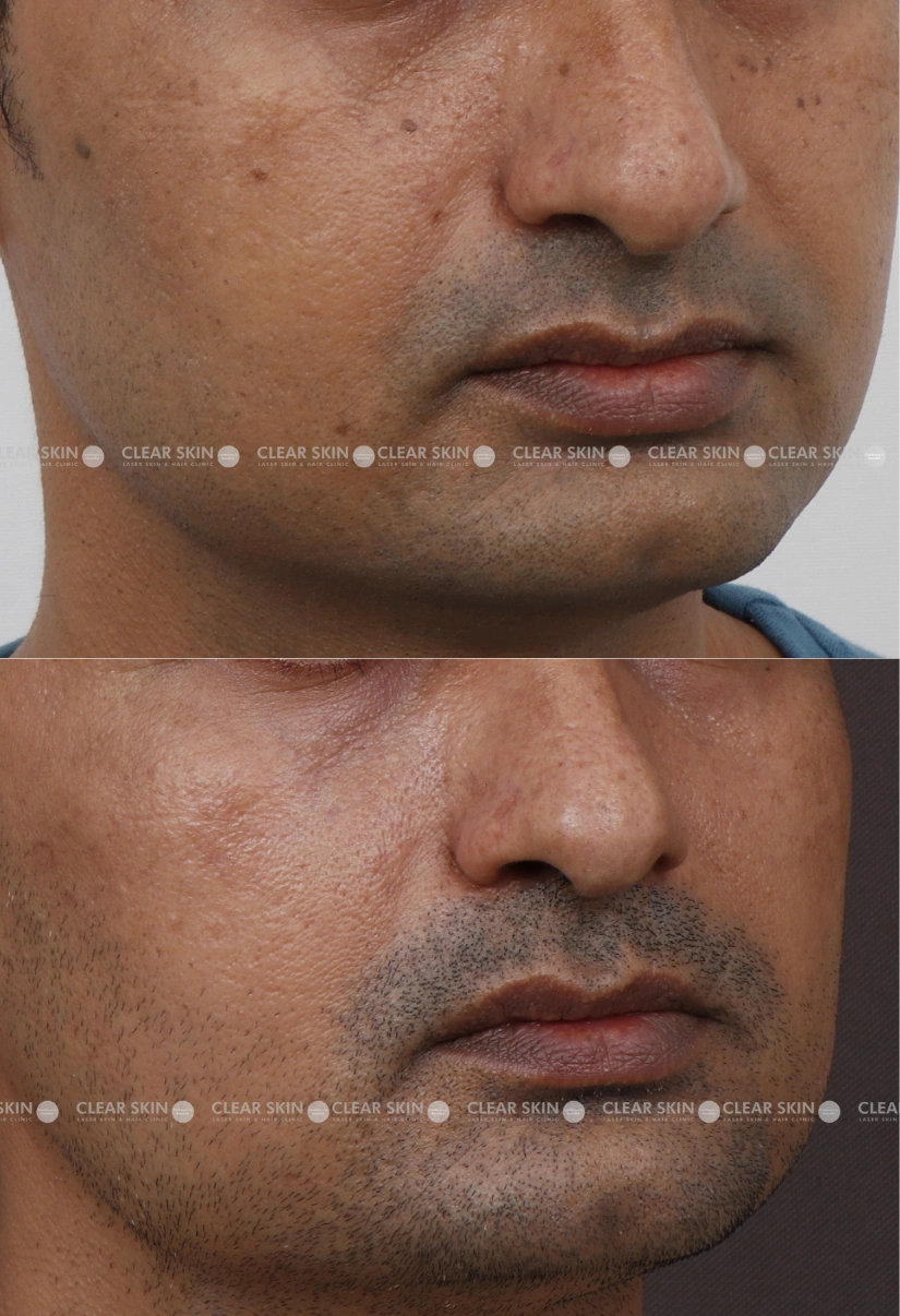 40yrs male DPN Results 4 Months Time line 3 Sessions ClearSkin Pune