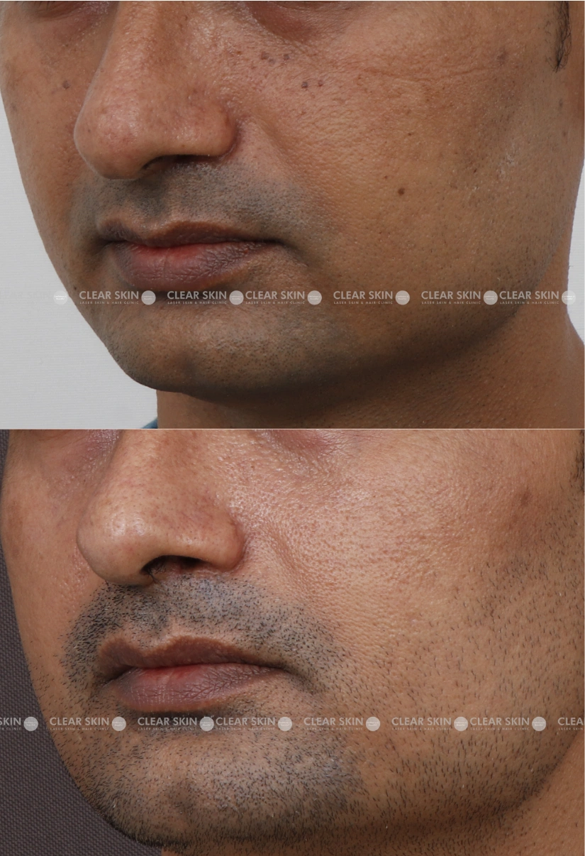 40yrs male DPN Results 4 Months Time line 3 Sessions ClearSkin Pune