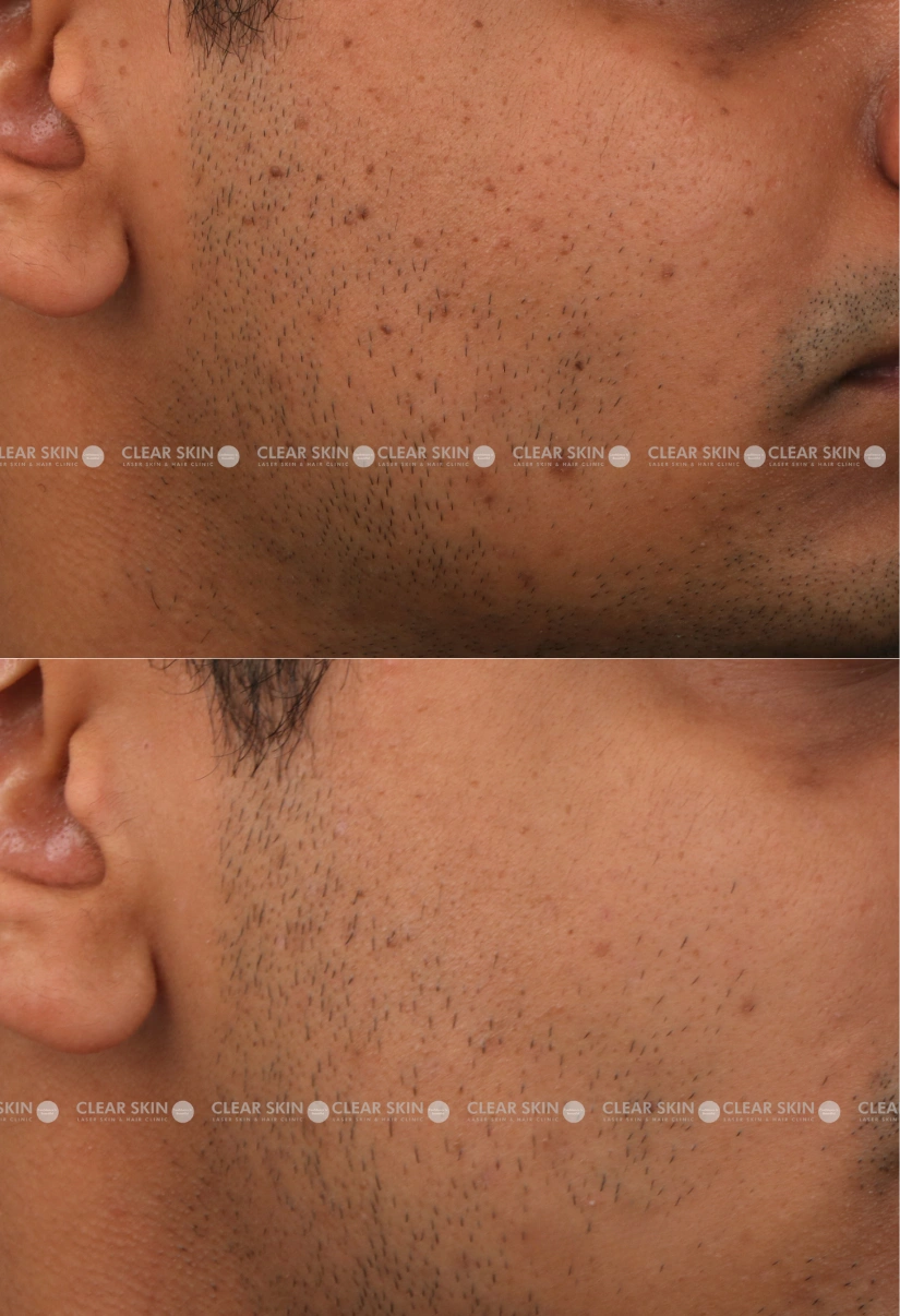 40yrs male DPN Results 4 Months Time line 3 Sessions ClearSkin Pune