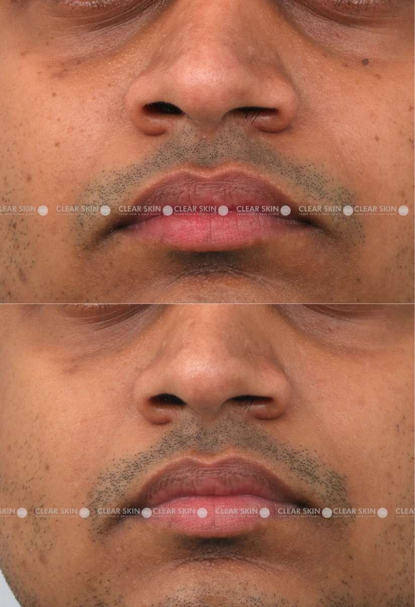 40yrs male DPN Results 4 Months Time line 3 Sessions ClearSkin Pune