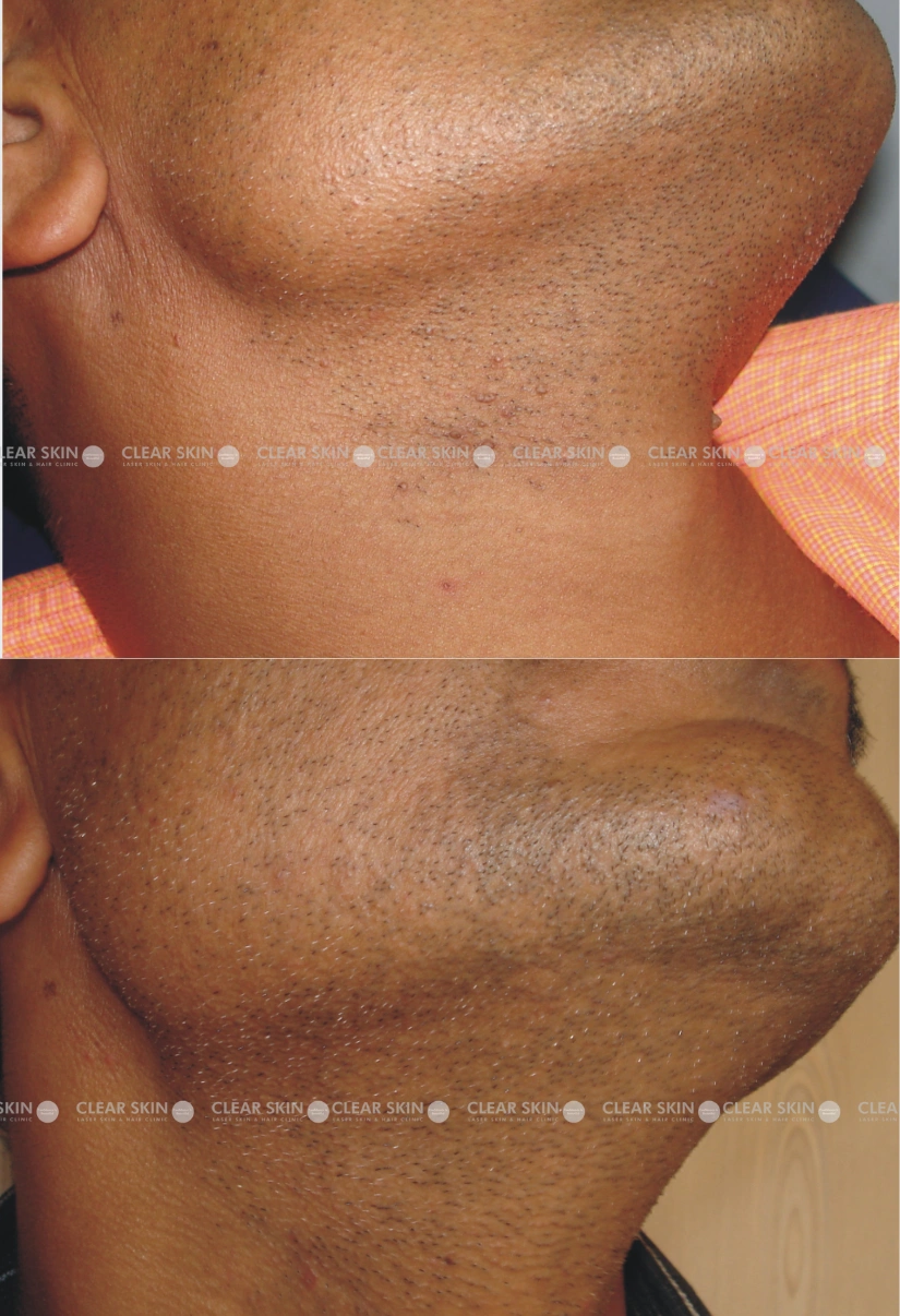 40yrs male Wart Removal Results 1 Months Timeline 1 Sessions ClearSkin Pune