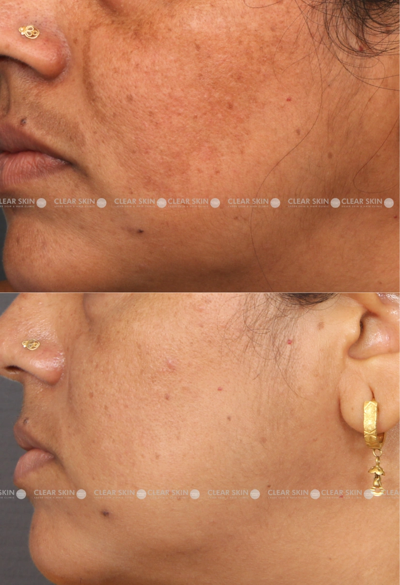 41yrs Female Melasma Results 8 Months Timeline 9 Sessions ClearSkin Pune (2)