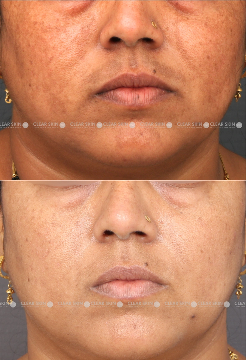 41yrs Female Melasma Results 8 Months Timeline 9 Sessions ClearSkin Pune (3)