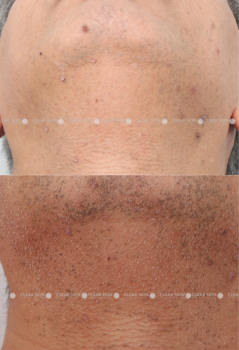 41yrs male Wart Removal Results 1 Months Timeline 1 Sessions ClearSkin Pune