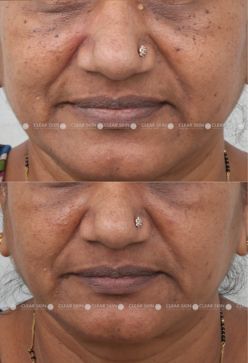 42yrs Female DPN Results 2 Months Time line 2 Sessions ClearSkin Pune