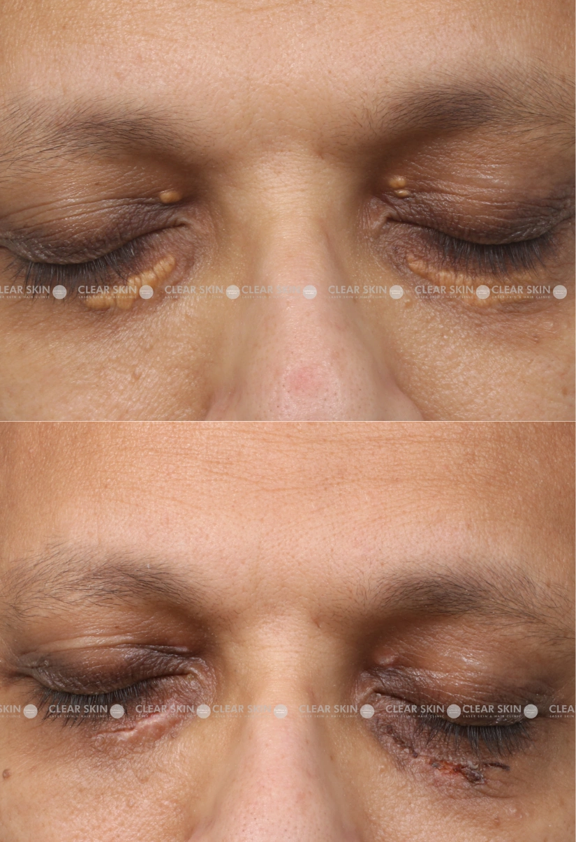 42yrs male Xanthalasma Results 1 Months Timeline 1 Sessions ClearSkin Pune