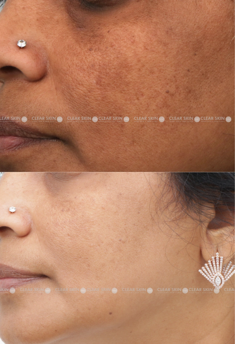 43years Female Anti Aging Results 4 Months Timeline 5 Sessions ClearSkin Pune 3