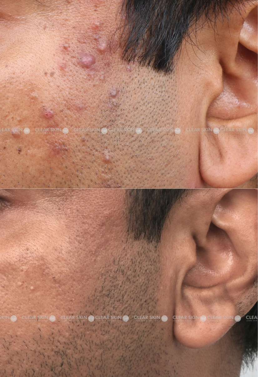 44yrs male DPN Results 9 Months Time line 8 Sessions ClearSkin Pune 