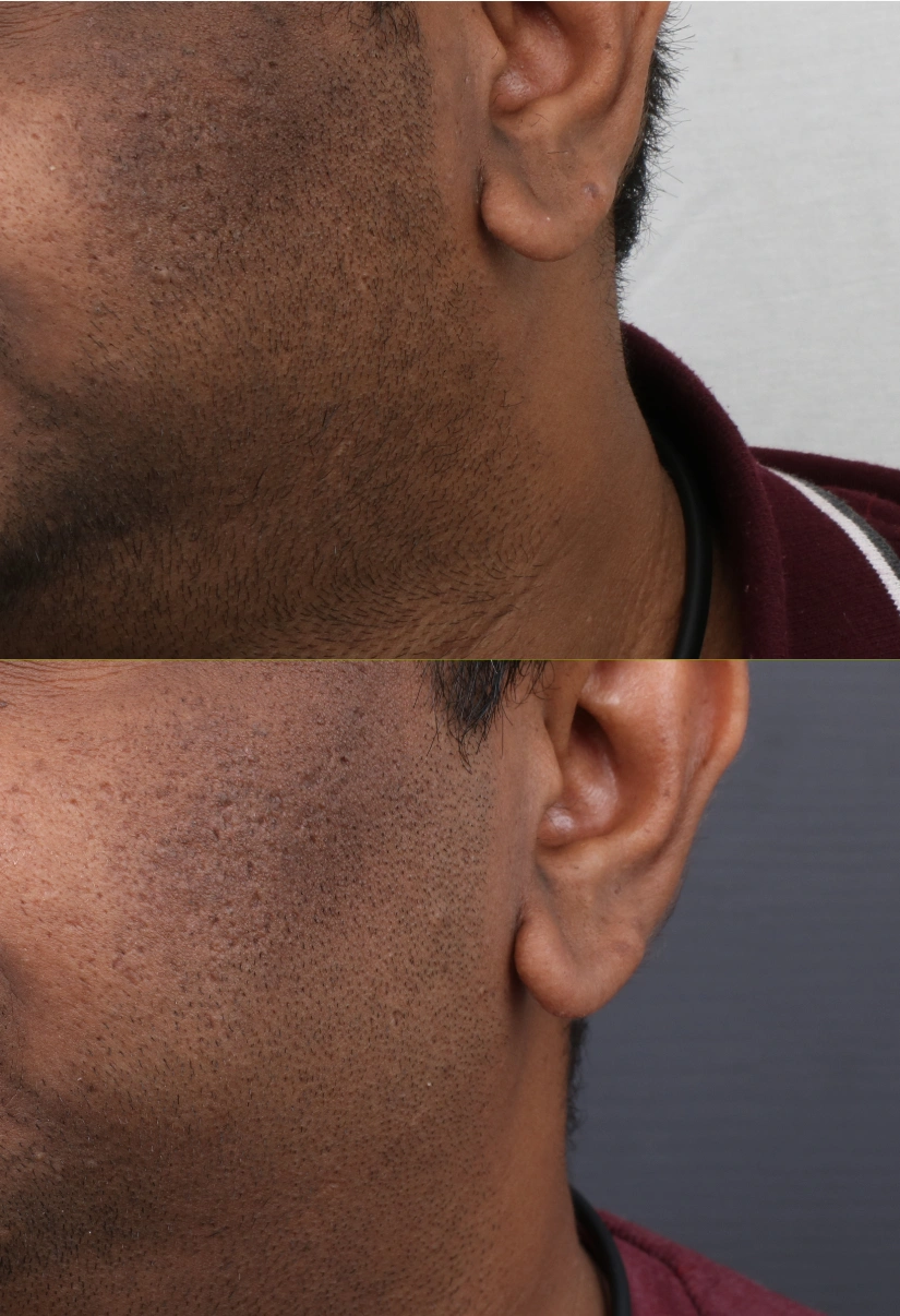 45yrs Pigmentation Results 4 Months Timeline 4 Sessions ClearSkin Pune (2)