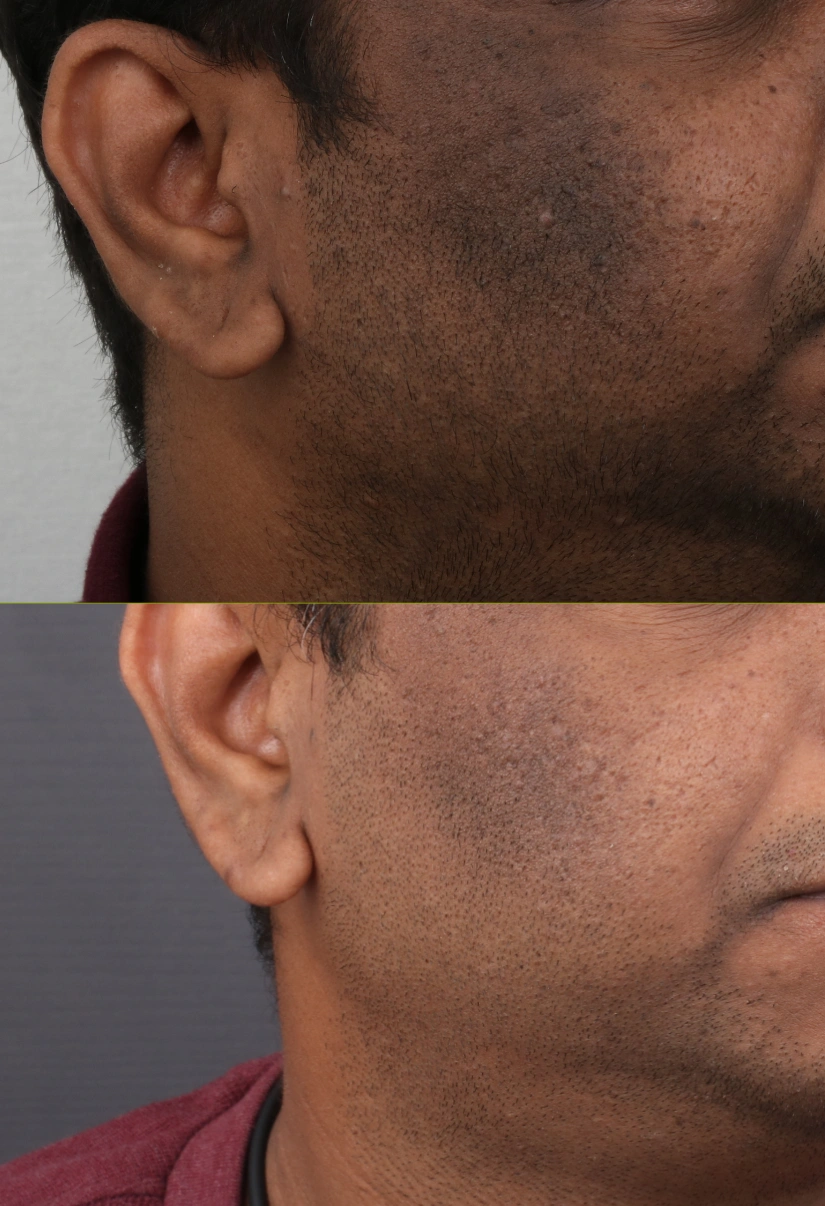 45yrs Pigmentation Results 4 Months Timeline 4 Sessions ClearSkin Pune