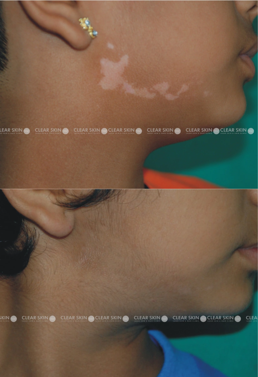 4years Female Vitiligo Results 3 Sessions 3 Months ClearSkin Pune 