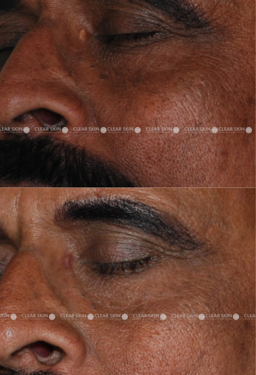 52yrs male Xanthalasma Results 1 Months Timeline 1 Sessions ClearSkin Pune (2)