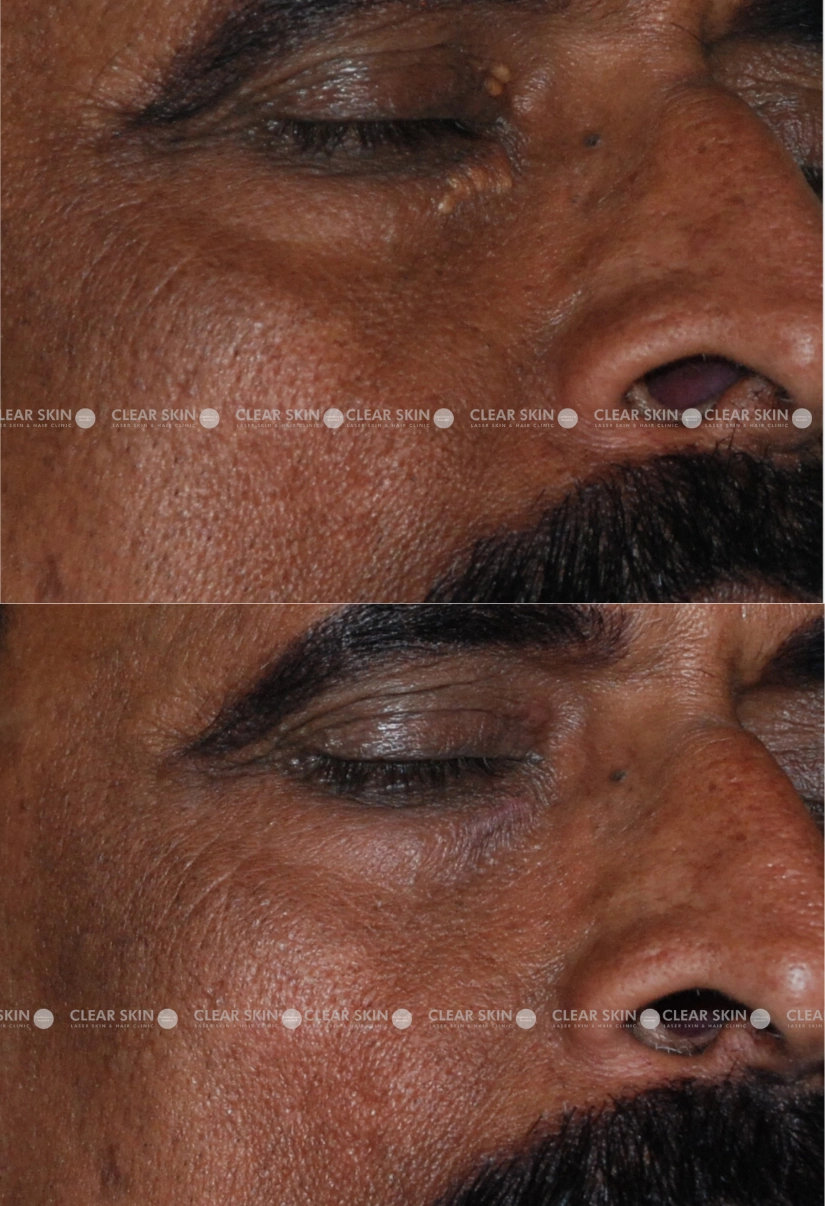 52yrs male Xanthalasma Results 1 Months Timeline 1 Sessions ClearSkin Pune