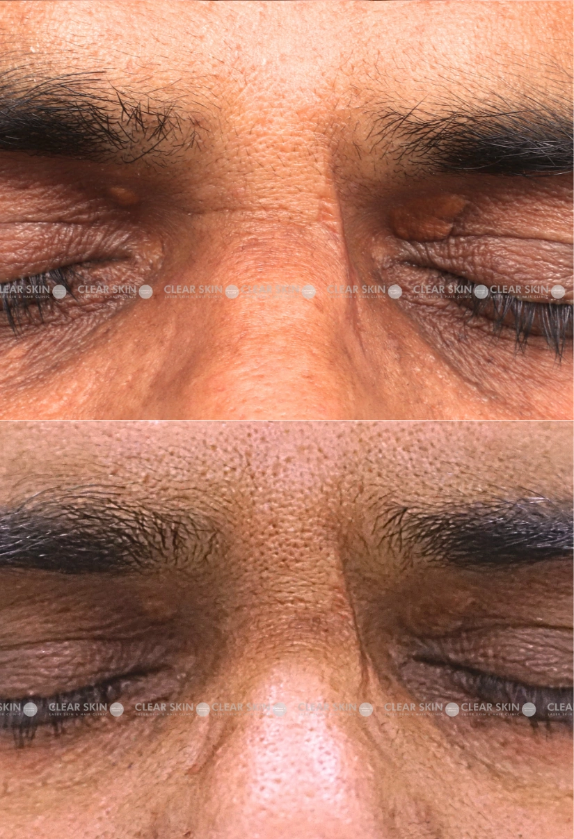 54yrs male Xanthalasma Results 1 Months Timeline 1 Sessions ClearSkin Pune