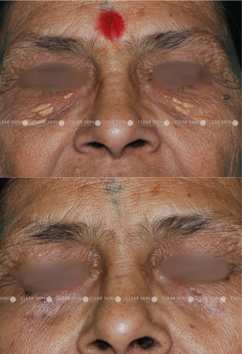 64yrs Female Xanthalasma Results 1 Months Timeline 1 Sessions ClearSkin Pune