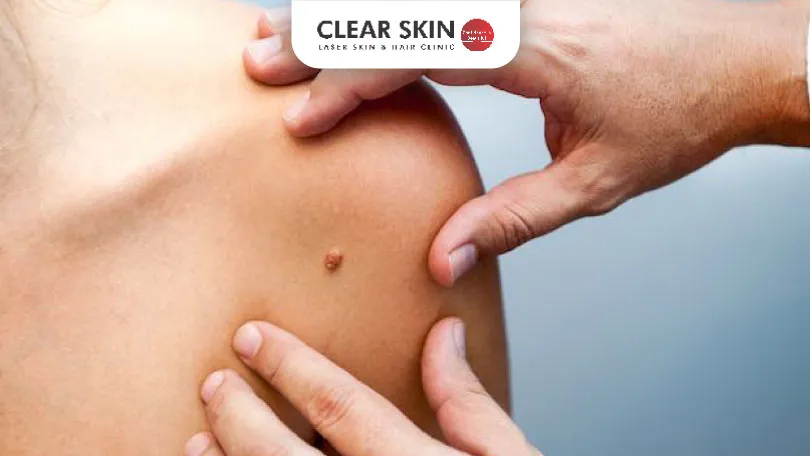 7-Warning-Signs-of-Skin-Cancer-You-Shouldn't-Ignore-Clear-Skin-Pune