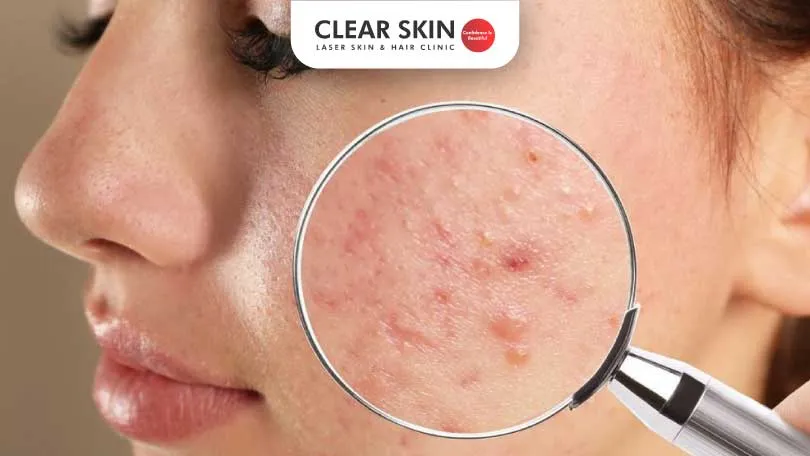 Unlocking the Secrets of Acne Treatment Costs in Pune: Your Go-To Guide!