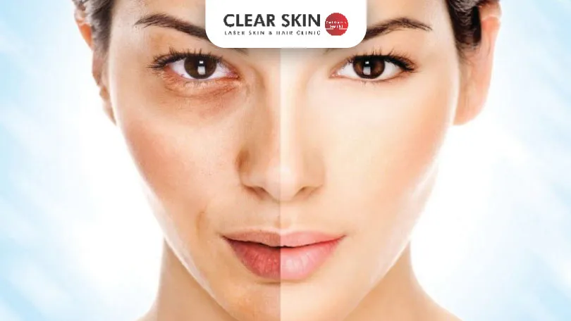 Comprehensive Guide to Melasma Treatment