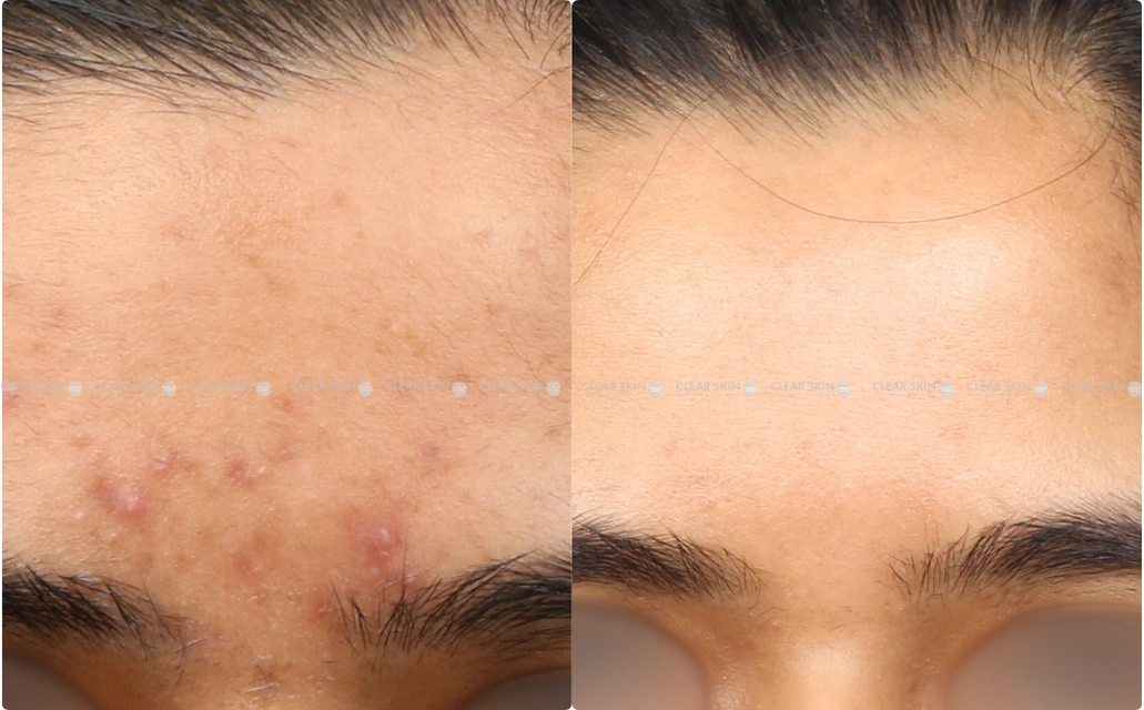 Acne Results 10 Sessions 10 Months Clear Skin Pune