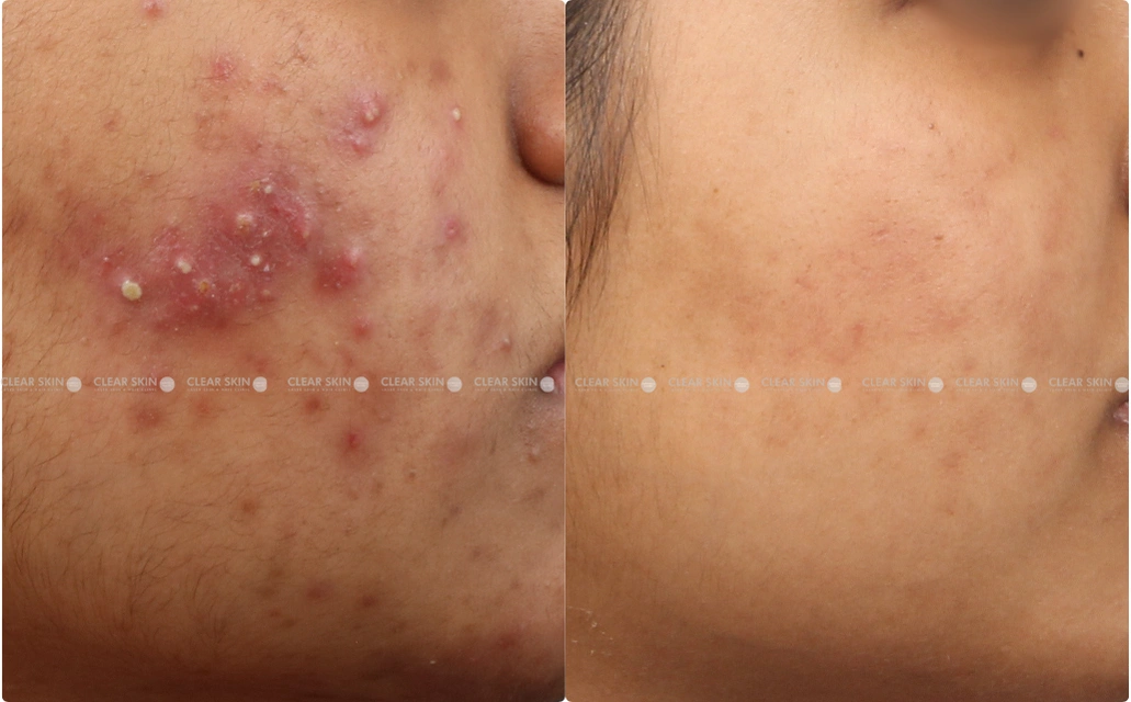 Acne Results 10 Sessions 10 Months ClearSkin Pune