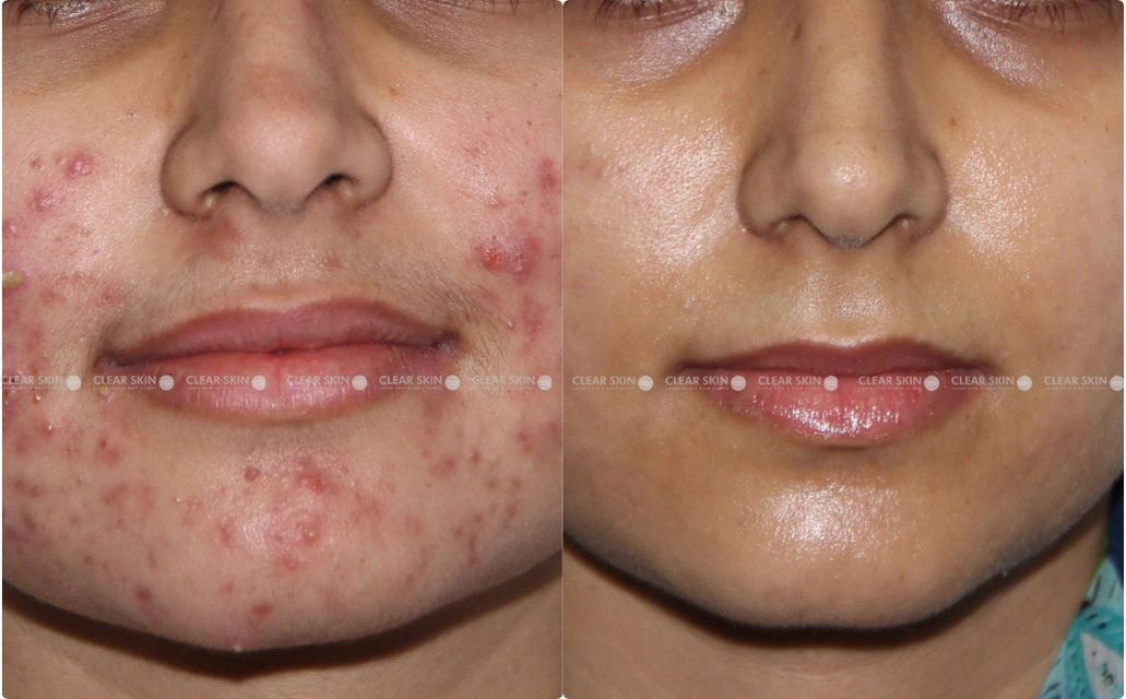 Acne Results 10 Sessions 7 Months ClearSkin Pune