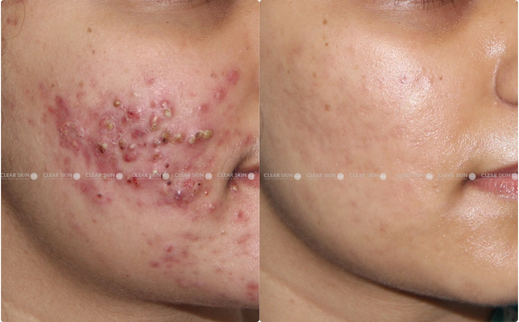 Acne Results 10 Sessions 7 Months ClearSkin Pune