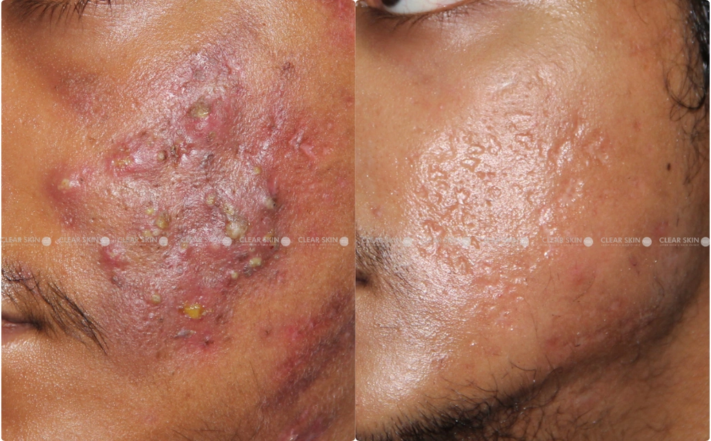 Acne Results 10 Sessions 8 Months ClearSkin Pune