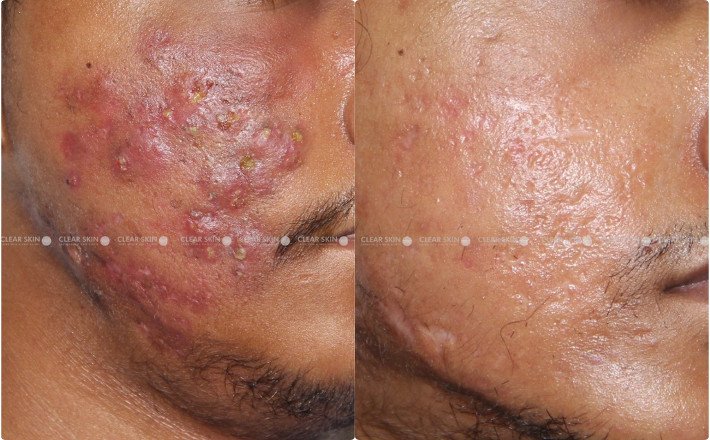 Acne Results 10 Sessions 8 Months ClearSkin Pune