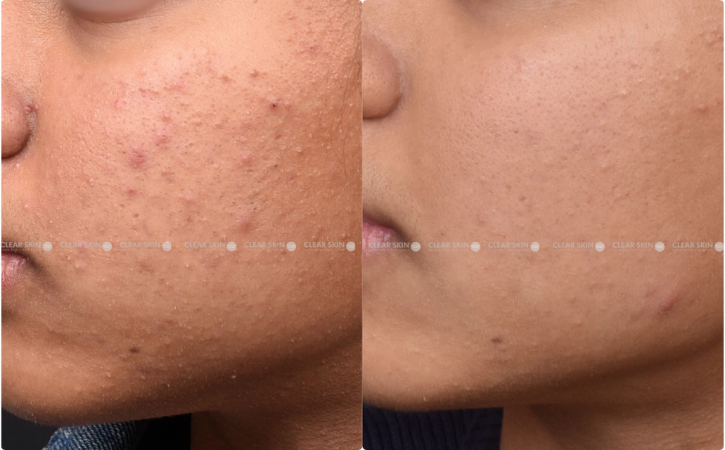 Acne Results 3 Sessions 6 Months ClearSkin Pune