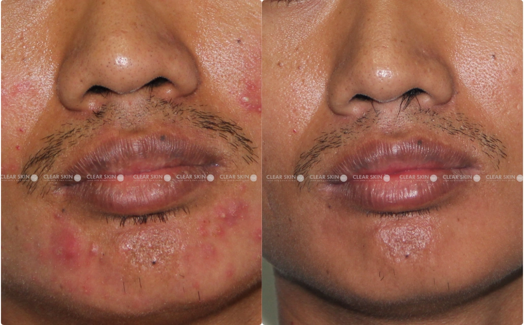 Acne Results 4 Sessions 4 Months ClearSkin Pune