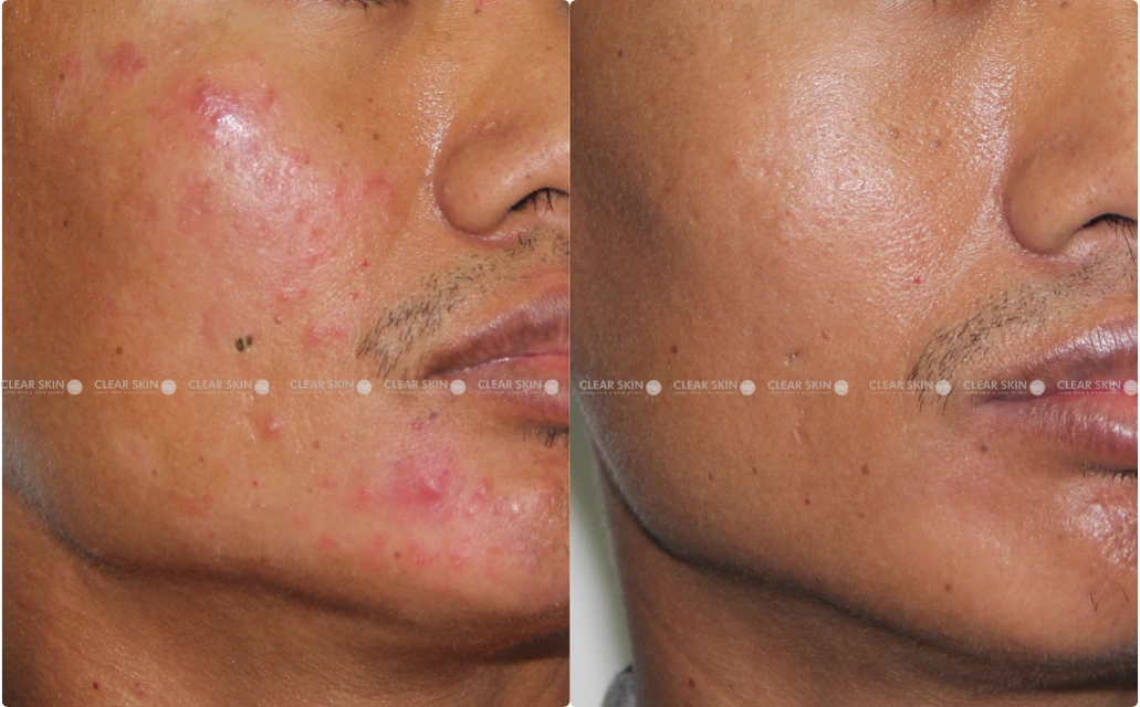 Acne Results 4 Sessions 4 Months ClearSkin Pune