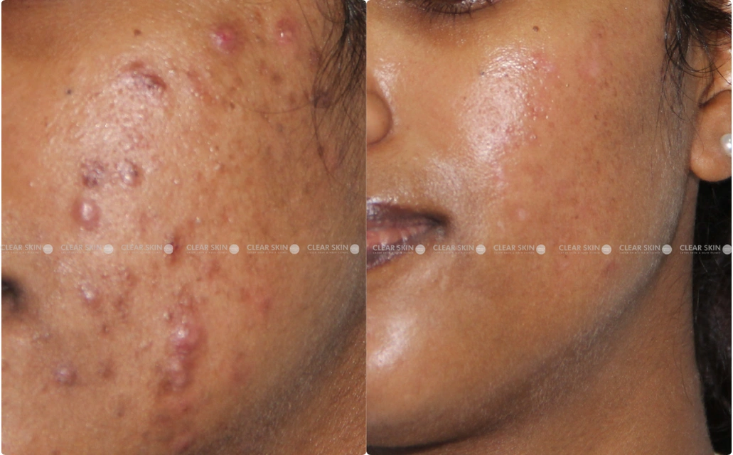 Acne Results 4 Sessions 6 Months ClearSkin Pune