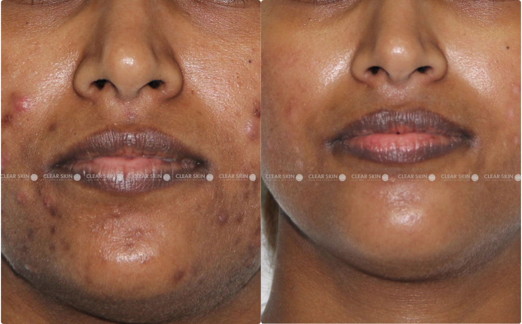 Acne Results 4 Sessions 6 Months ClearSkin Pune