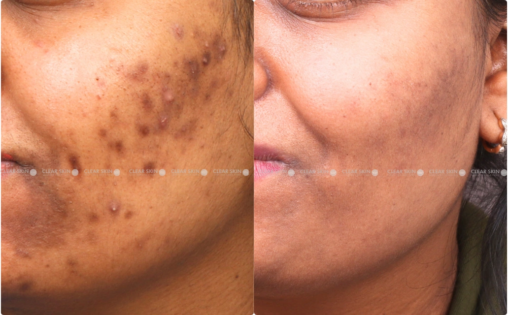 Acne Results 5 Months 6 Sessions ClearSkin Pune