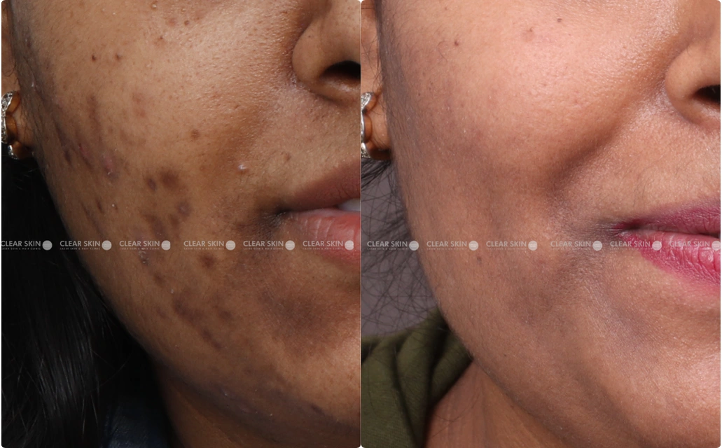 Acne Results 5 Months 6 Sessions ClearSkin Pune