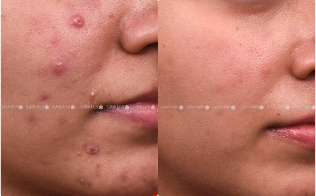 Acne Results 5 Sessions 4 Months ClearSkin Pune