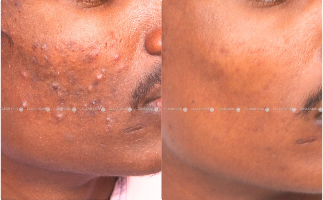 Acne Results 5 Sessions 6 Months ClearSkin Pune