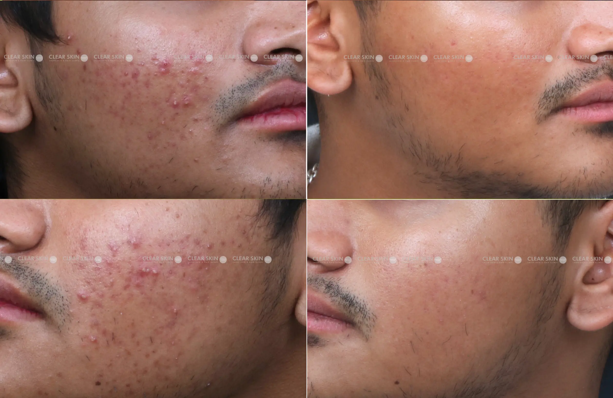 Acne Results 6 Months Timeline 7 Sessions ClearSkin Pune