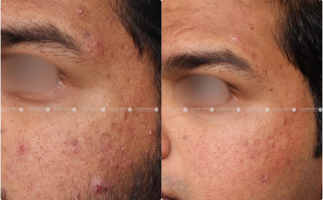 Acne Results 6 Sessions 5 Months ClearSkin Pune