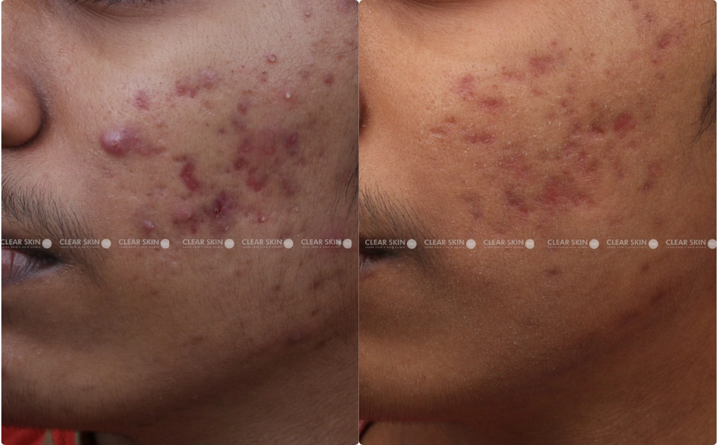 Acne Results 6 Sessions 5 Months ClearSkin Pune