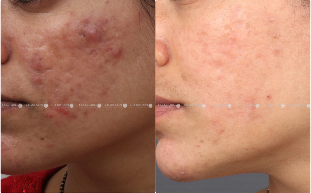 Acne Results 6 Sessions 6 Months ClearSkin Pune