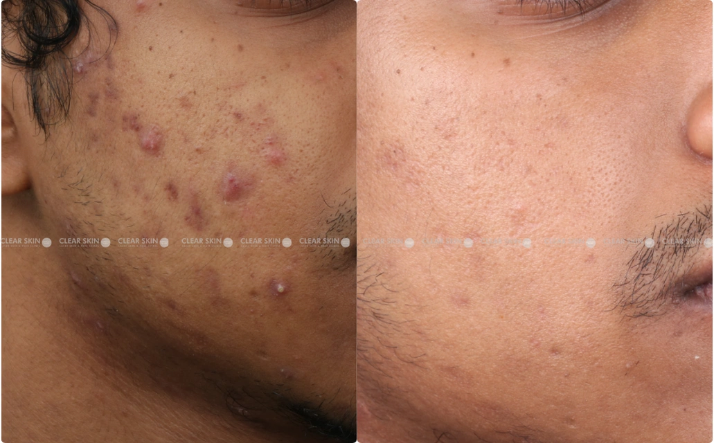 Acne Results 6 Sessions 6 Months ClearSkin Pune