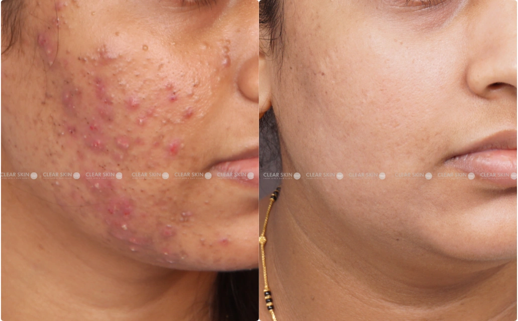 Acne Results 6 Sessions 7 Months ClearSkin Pune