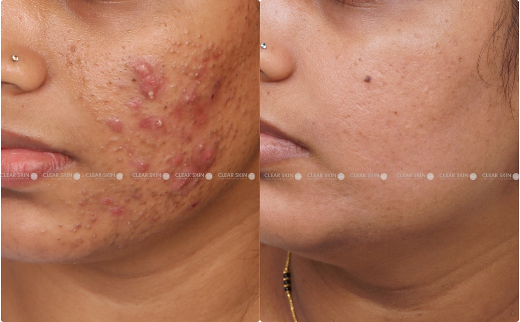 Acne Results 6 Sessions 7 Months ClearSkin Pune