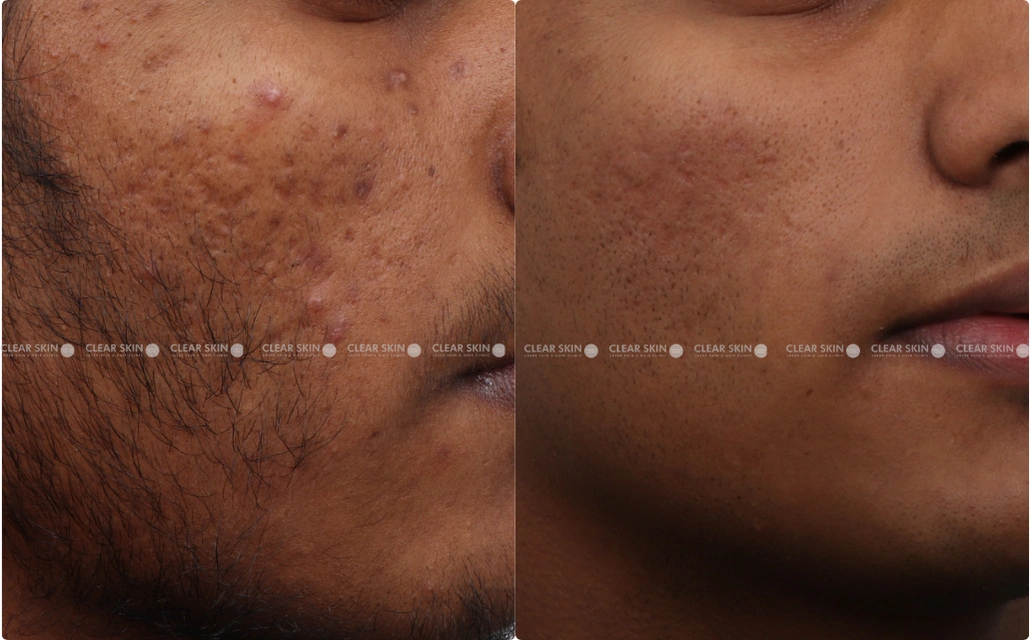 Acne Results 6 Sessions 7 Months ClearSkin Pune