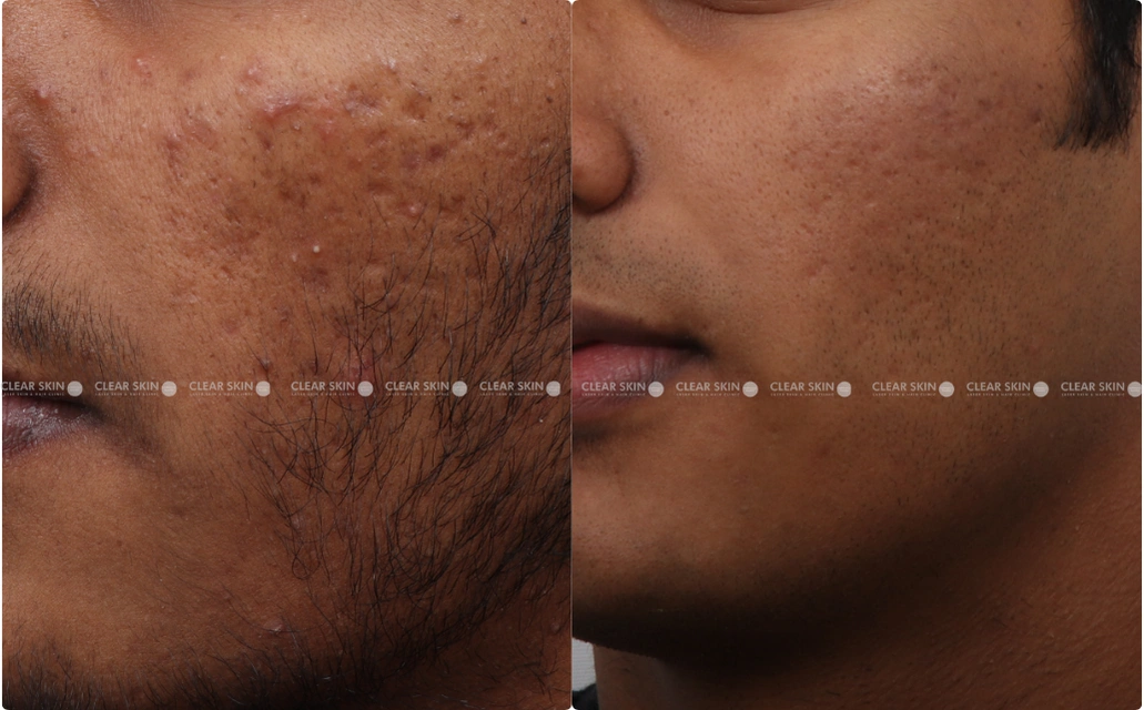 Acne Results 6 Sessions 7 Months ClearSkin Pune